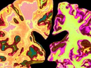 阿兹海默症可逆转 哈佛团队已着手人体临床试验